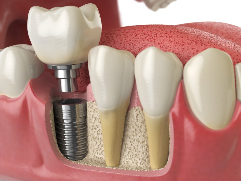 Zubni implantat
